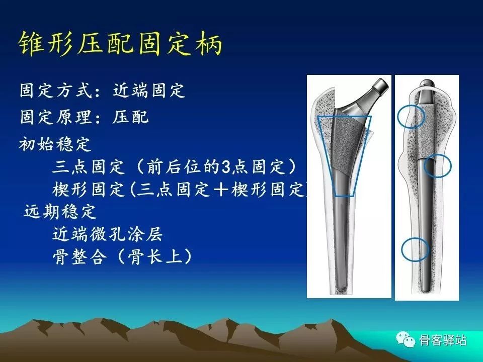 初次全髋关节置换术，技巧要点都在这！