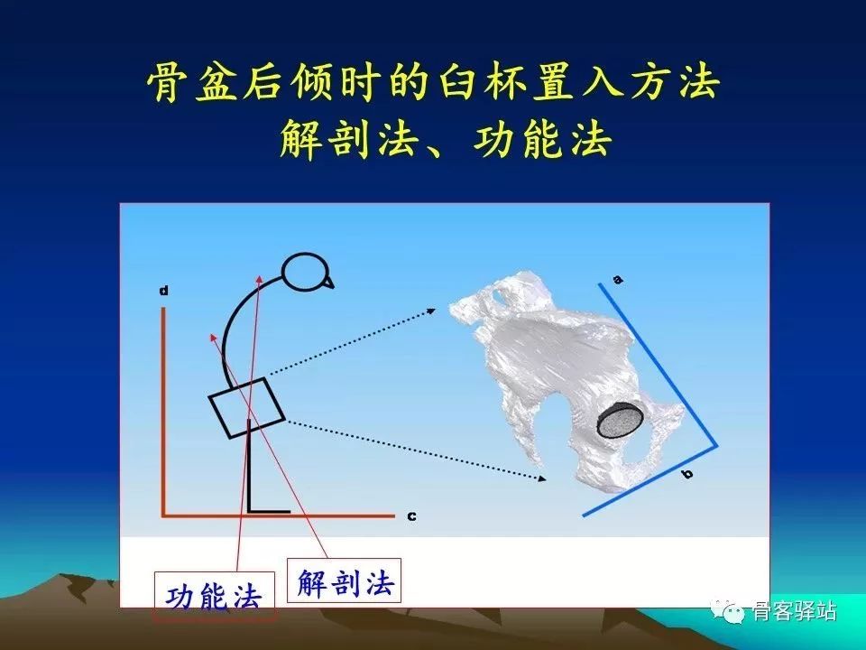 初次全髋关节置换术，技巧要点都在这！