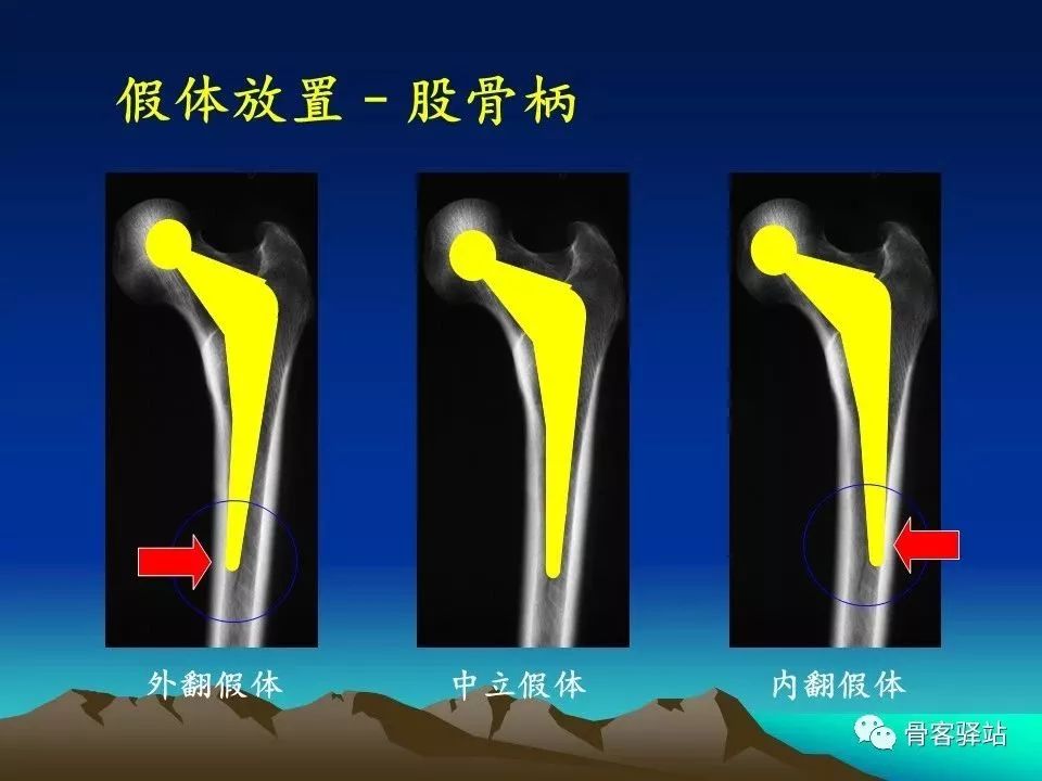 初次全髋关节置换术，技巧要点都在这！