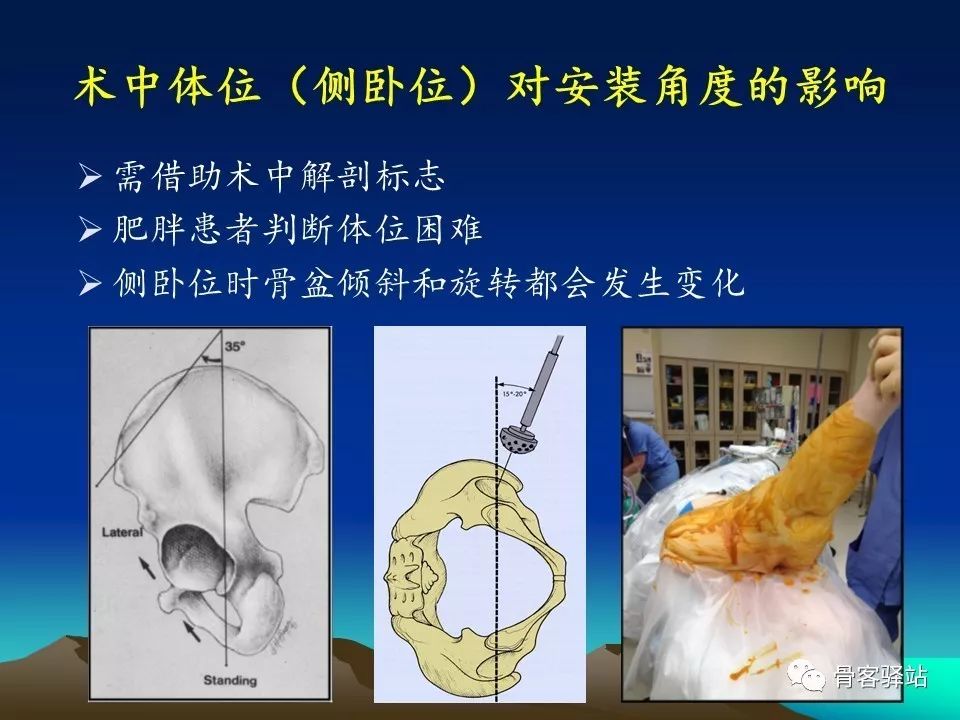 初次全髋关节置换术，技巧要点都在这！