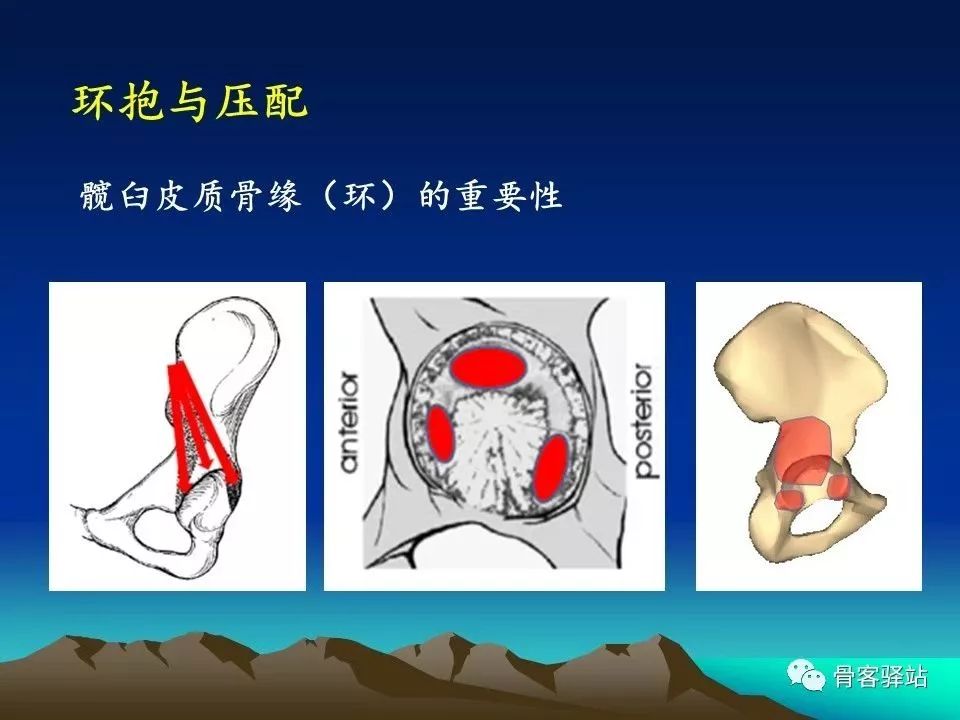 初次全髋关节置换术，技巧要点都在这！