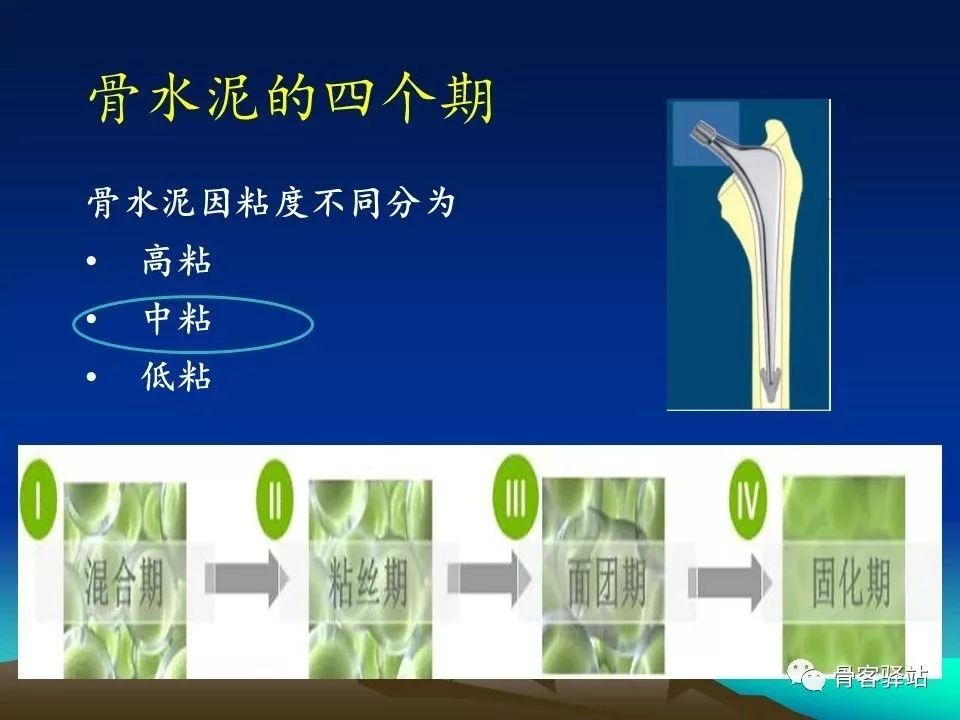 初次全髋关节置换术，技巧要点都在这！