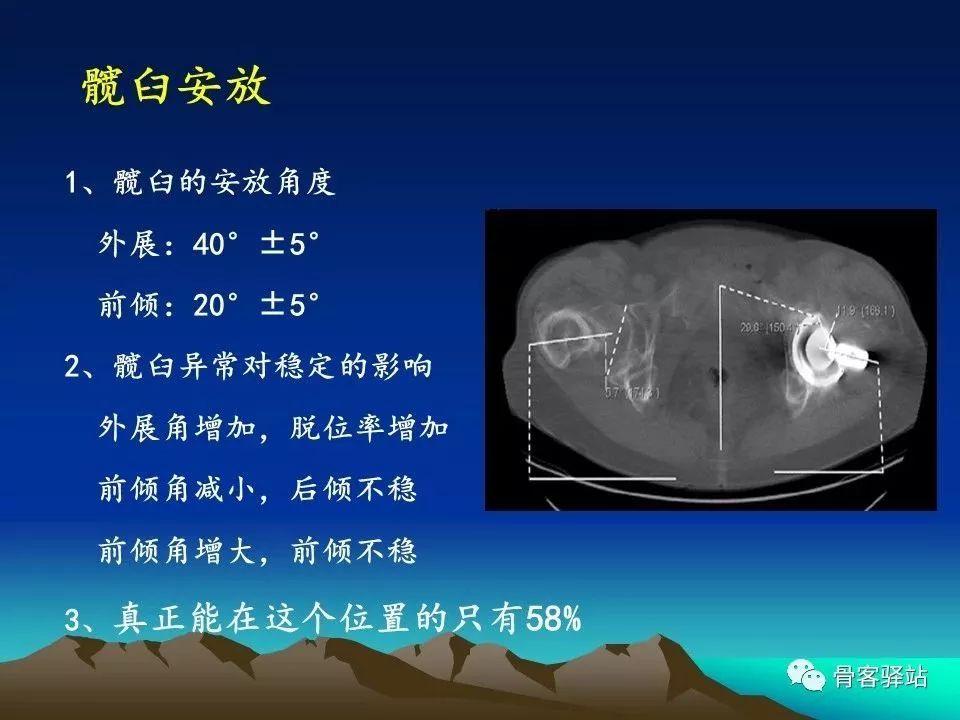 初次全髋关节置换术，技巧要点都在这！