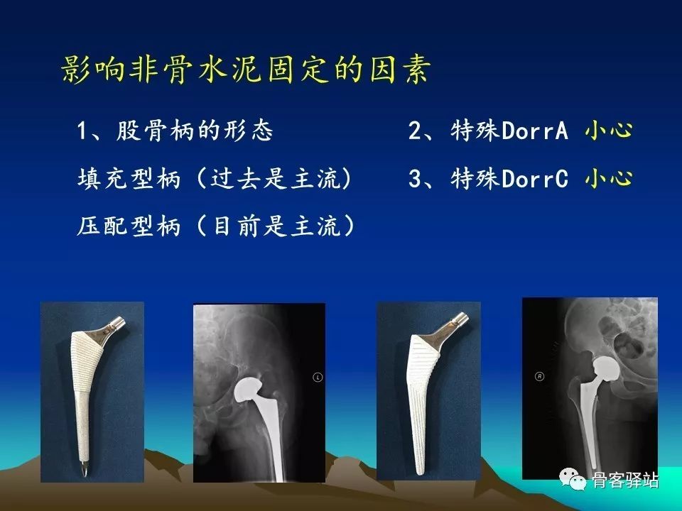 初次全髋关节置换术，技巧要点都在这！