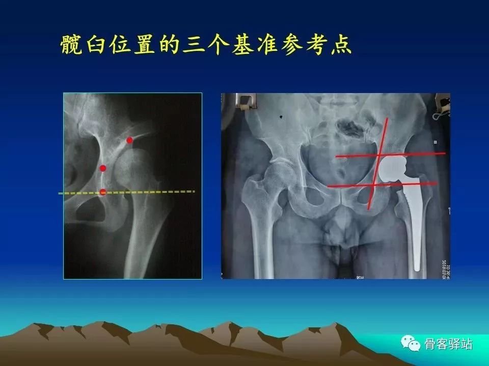 初次全髋关节置换术，技巧要点都在这！