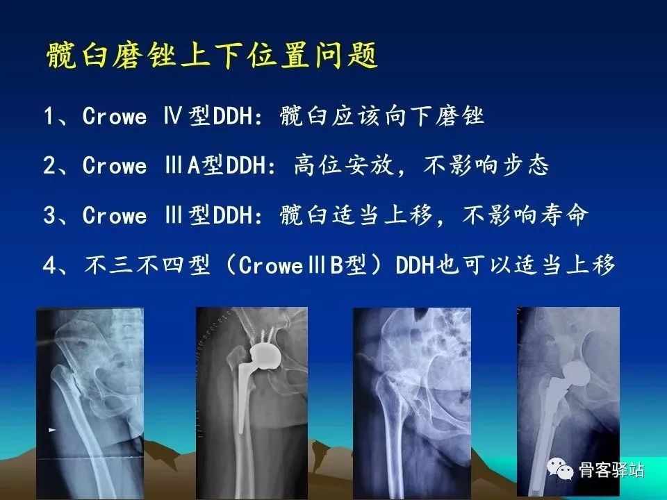 初次全髋关节置换术，技巧要点都在这！