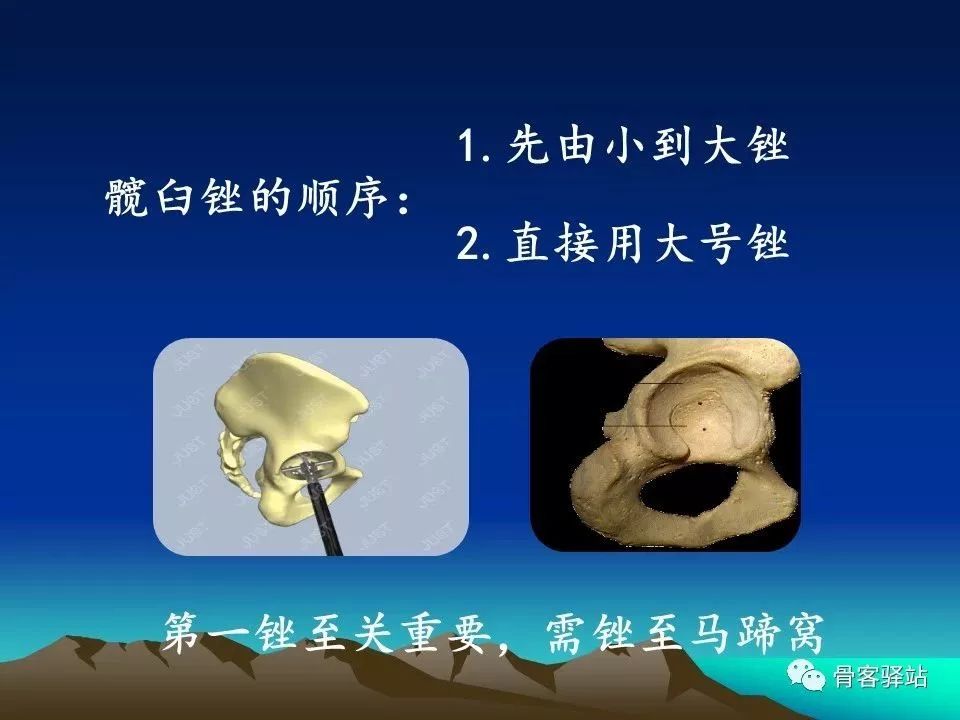 初次全髋关节置换术，技巧要点都在这！