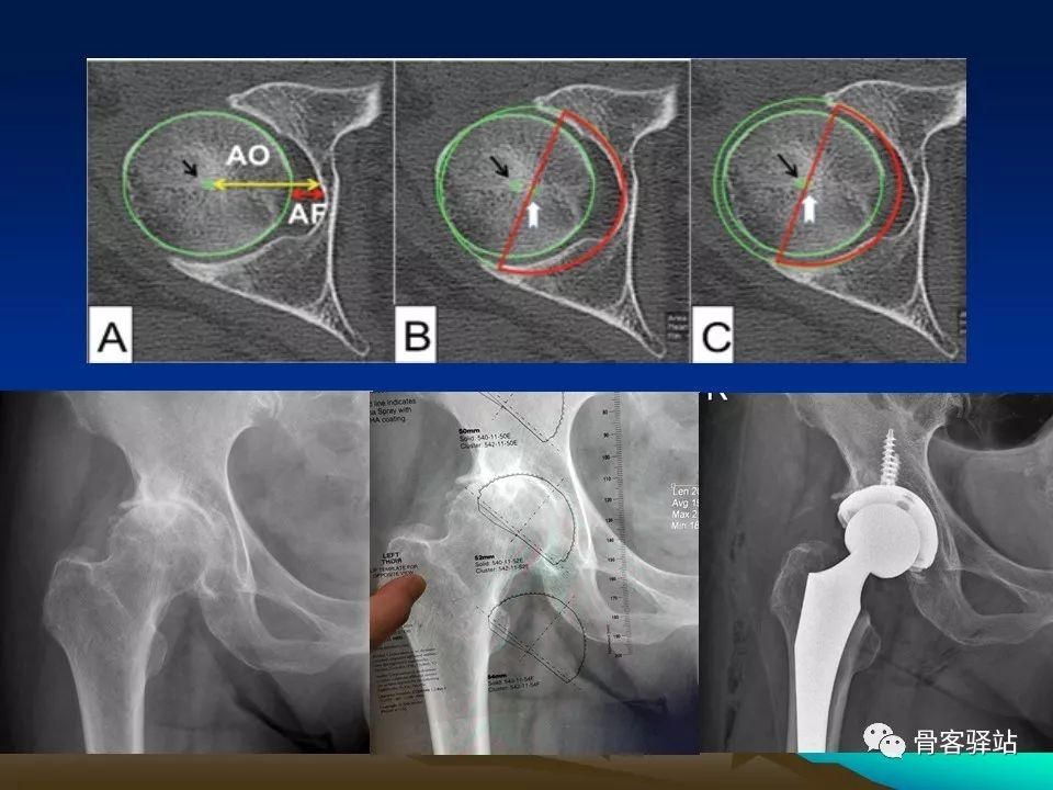 初次全髋关节置换术，技巧要点都在这！
