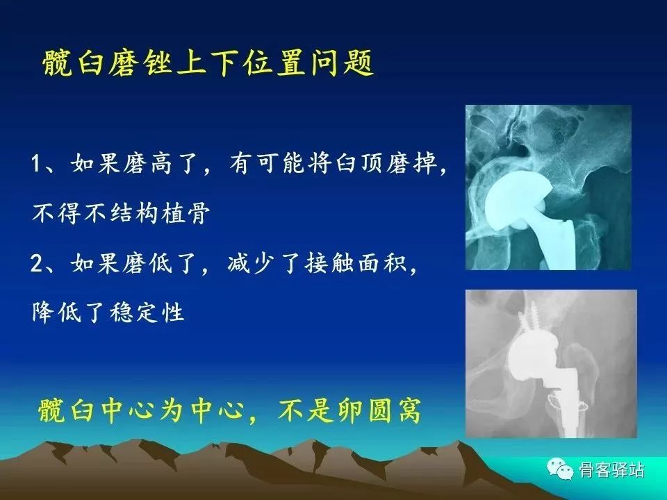 初次全髋关节置换术，技巧要点都在这！