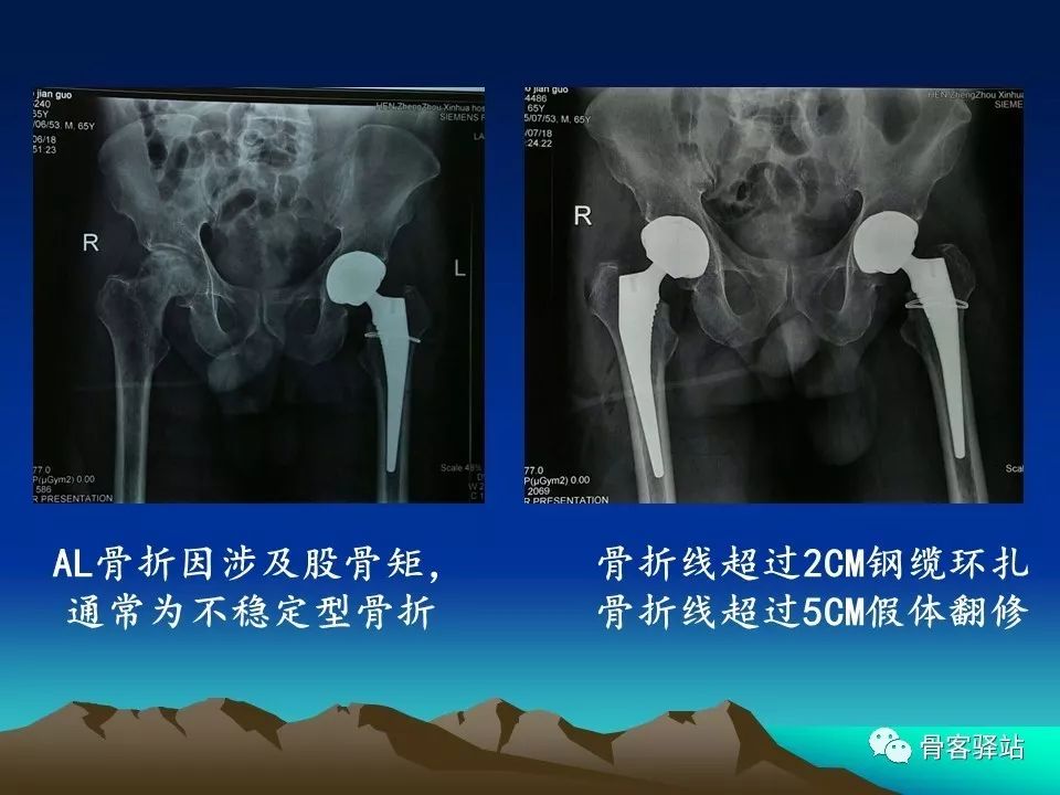 初次全髋关节置换术，技巧要点都在这！