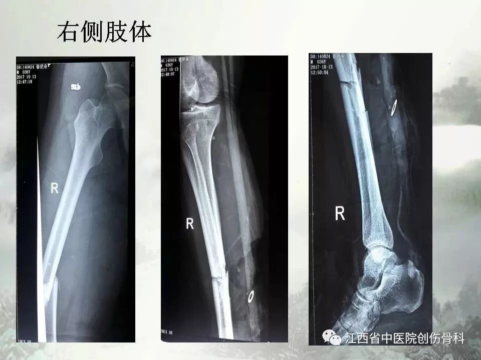 一文详解：髓内钉在下肢骨折应用