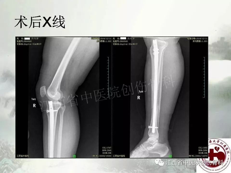 一文详解：髓内钉在下肢骨折应用