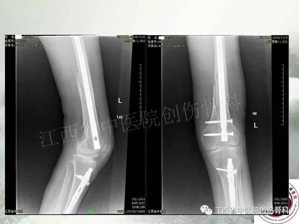 一文详解：髓内钉在下肢骨折应用