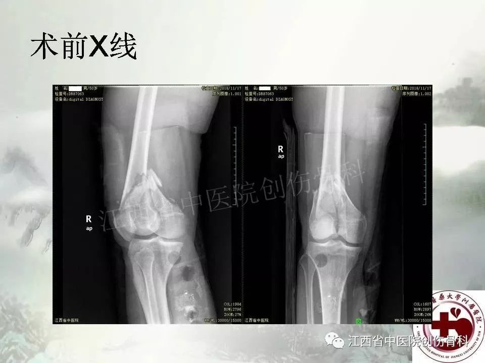 一文详解：髓内钉在下肢骨折应用