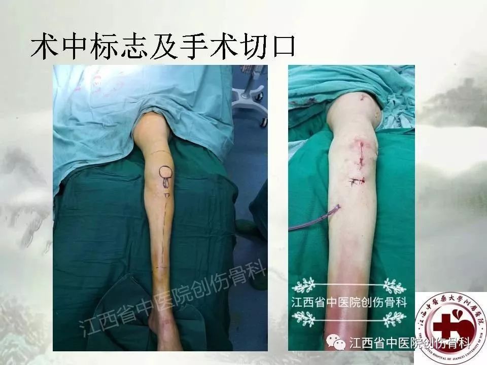 一文详解：髓内钉在下肢骨折应用