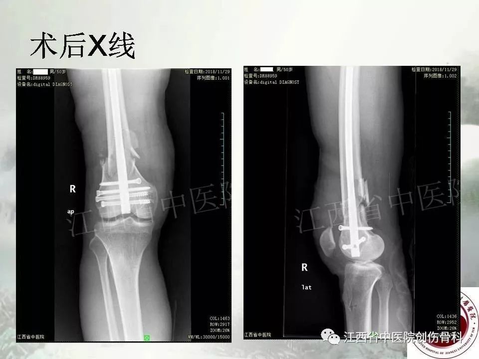 一文详解：髓内钉在下肢骨折应用