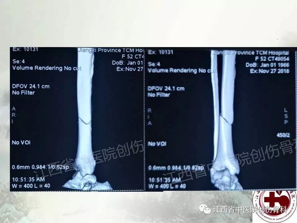 一文详解：髓内钉在下肢骨折应用