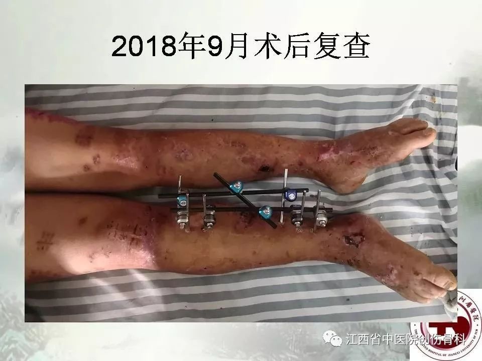 一文详解：髓内钉在下肢骨折应用