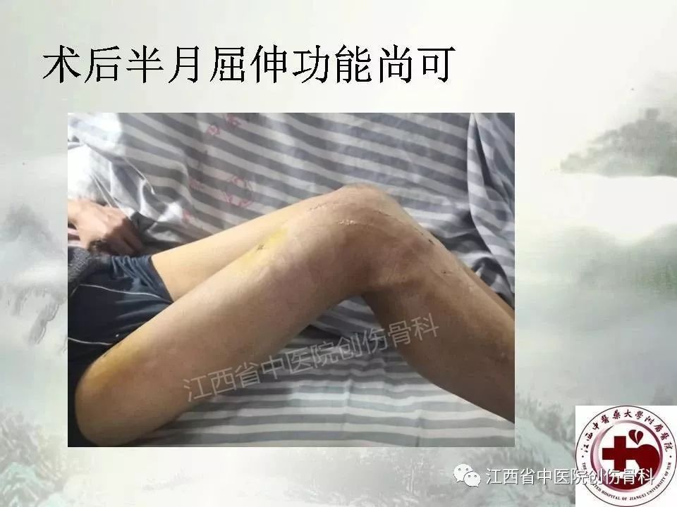 一文详解：髓内钉在下肢骨折应用