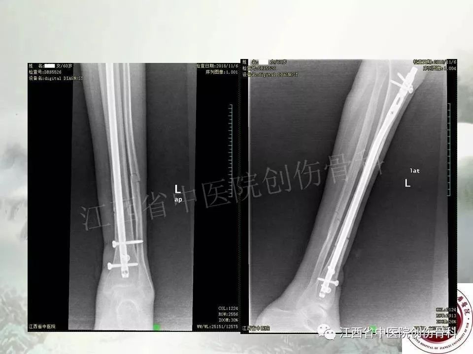 一文详解：髓内钉在下肢骨折应用