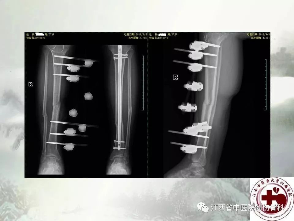 一文详解：髓内钉在下肢骨折应用