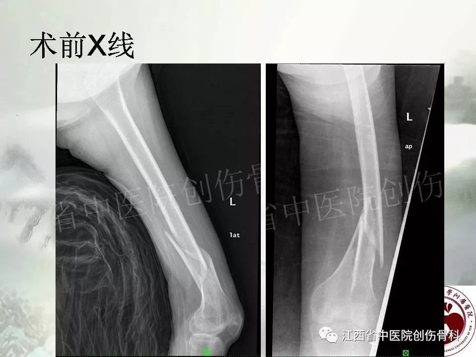 一文详解：髓内钉在下肢骨折应用