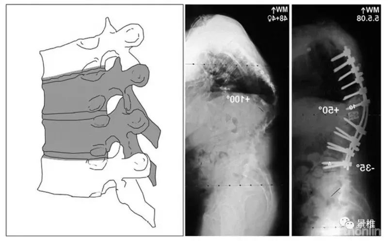 图文并茂！详解脊柱6级截骨术