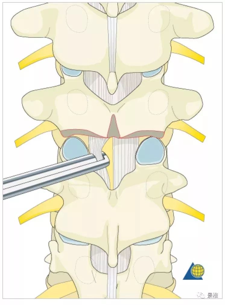 图文并茂！详解脊柱6级截骨术