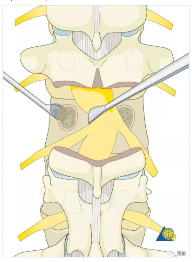 图文并茂！详解脊柱6级截骨术