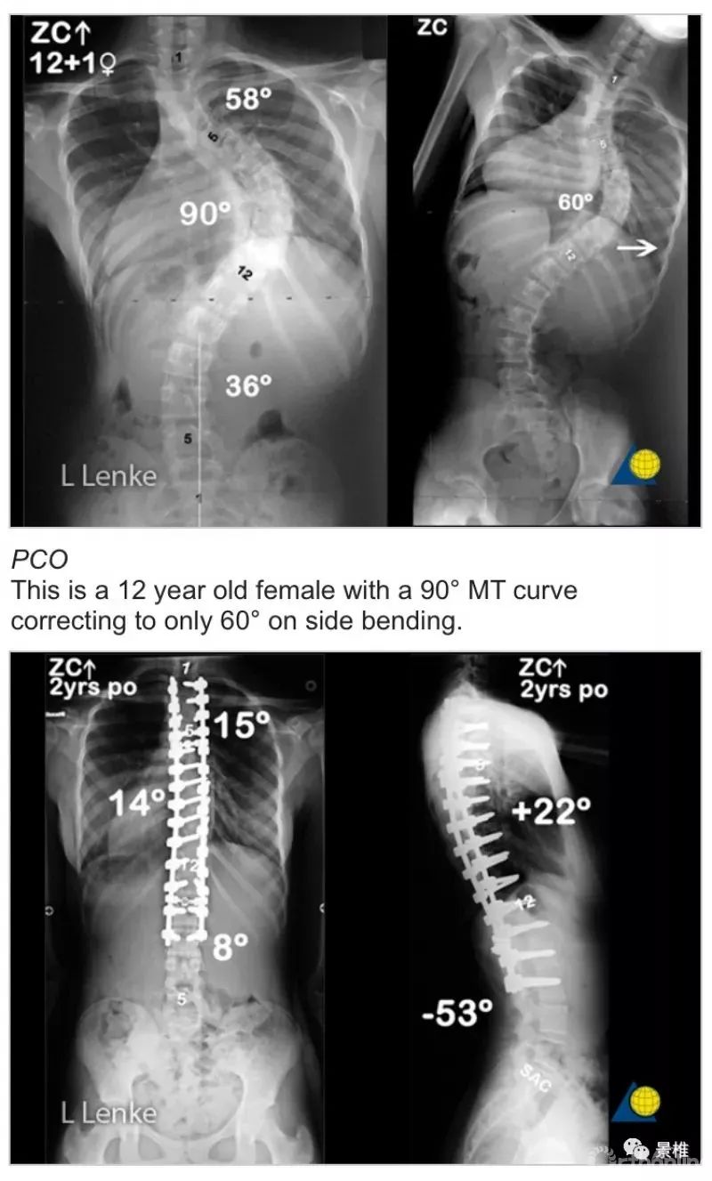 图文并茂！详解脊柱6级截骨术
