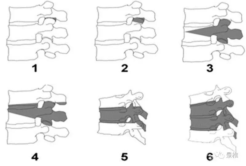 图文并茂！详解脊柱6级截骨术