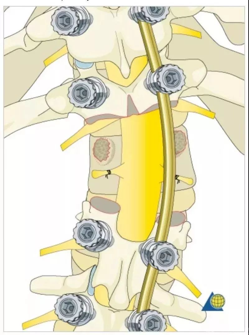图文并茂！详解脊柱6级截骨术