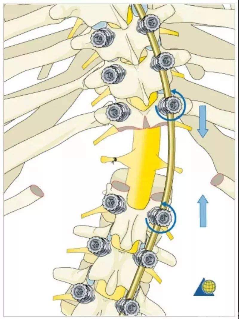 图文并茂！详解脊柱6级截骨术