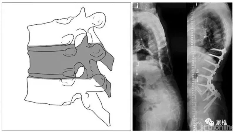 图文并茂！详解脊柱6级截骨术