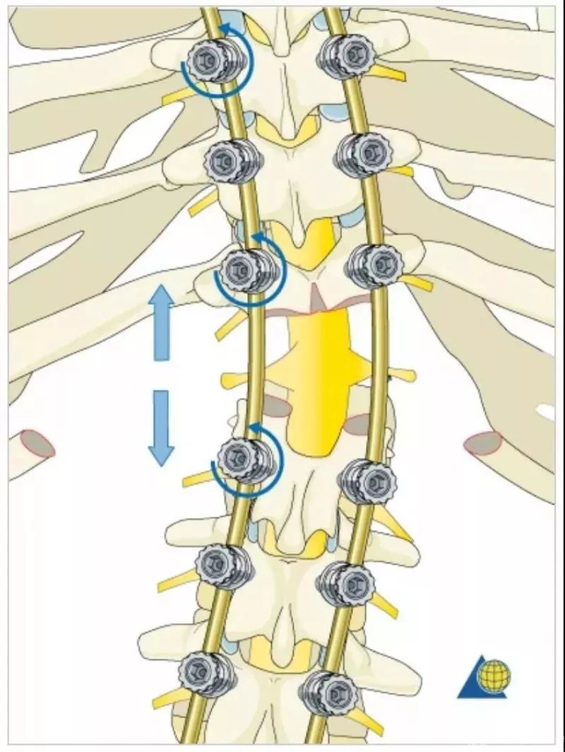 图文并茂！详解脊柱6级截骨术