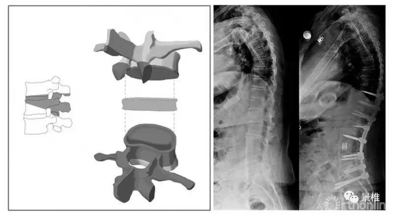 图文并茂！详解脊柱6级截骨术