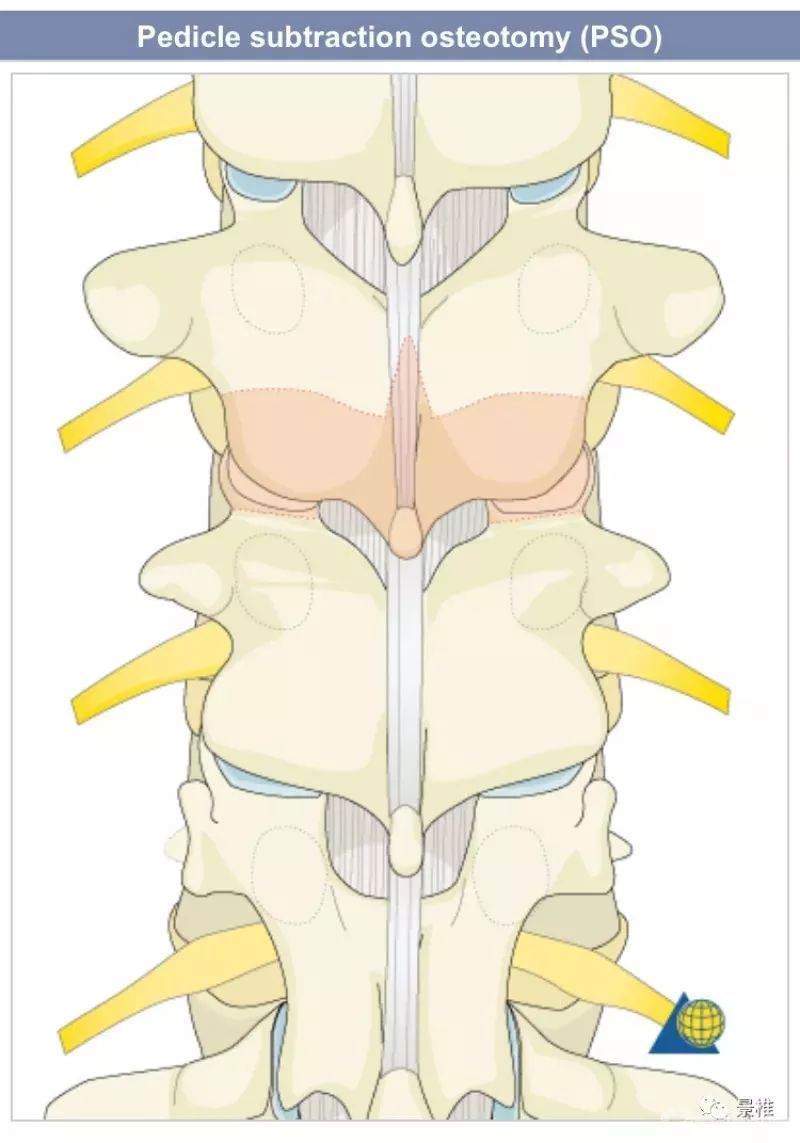 图文并茂！详解脊柱6级截骨术