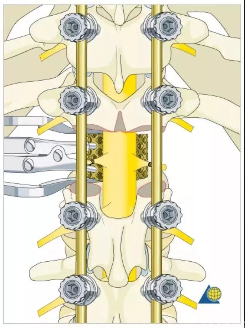 图文并茂！详解脊柱6级截骨术