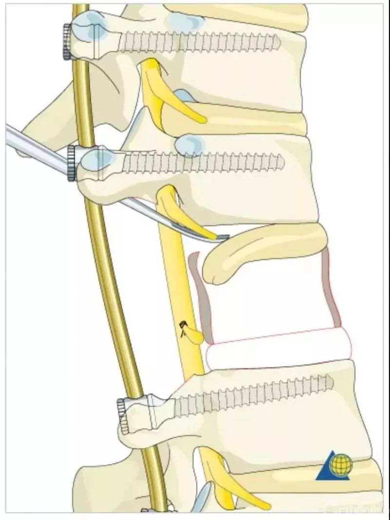 图文并茂！详解脊柱6级截骨术
