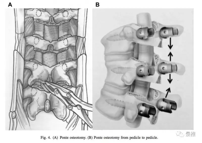 图文并茂！详解脊柱6级截骨术