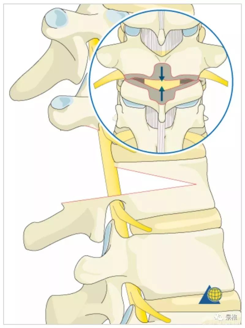 图文并茂！详解脊柱6级截骨术