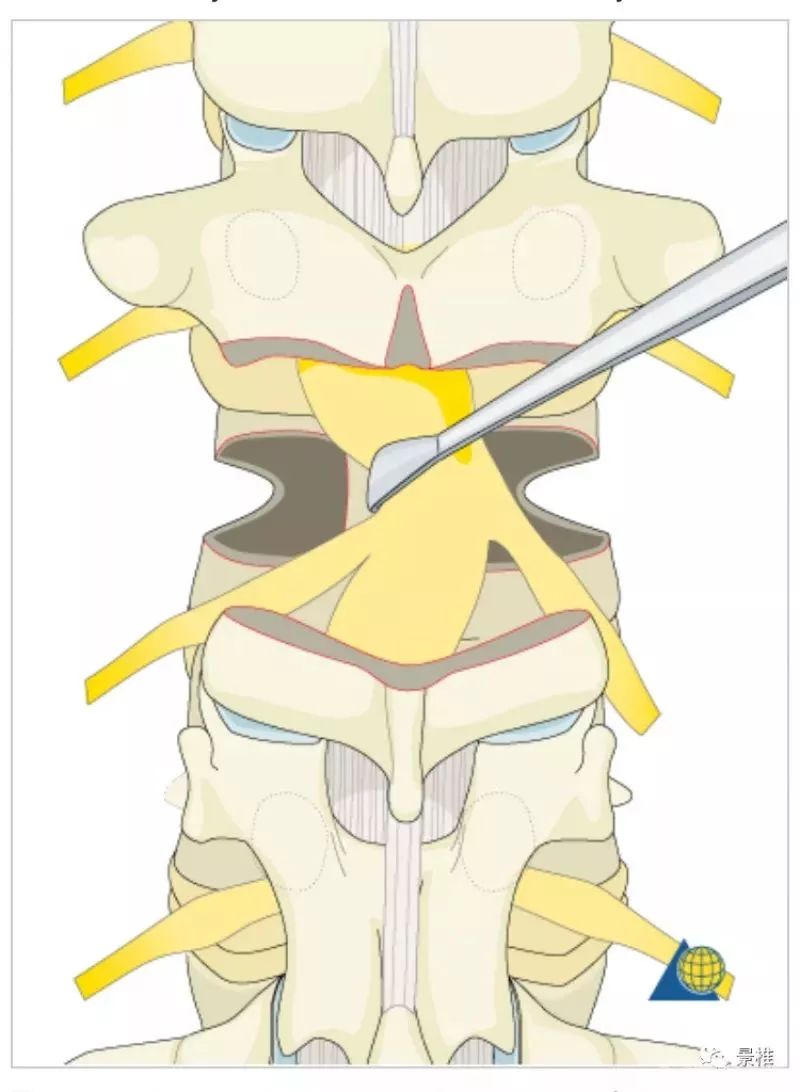 图文并茂！详解脊柱6级截骨术