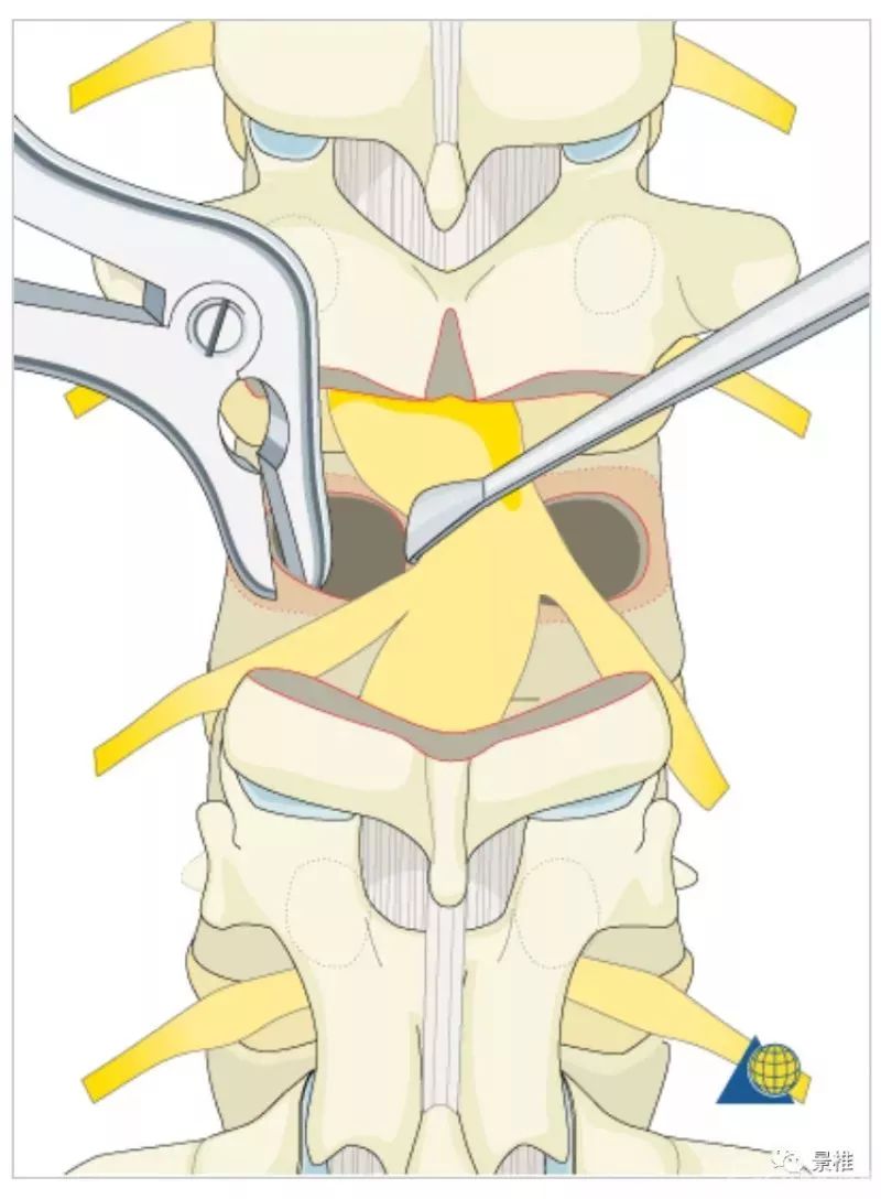 图文并茂！详解脊柱6级截骨术
