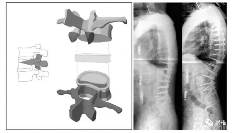图文并茂！详解脊柱6级截骨术