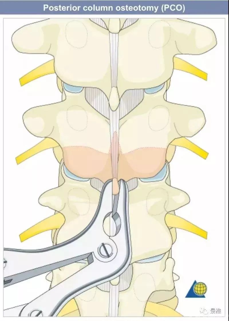 图文并茂！详解脊柱6级截骨术