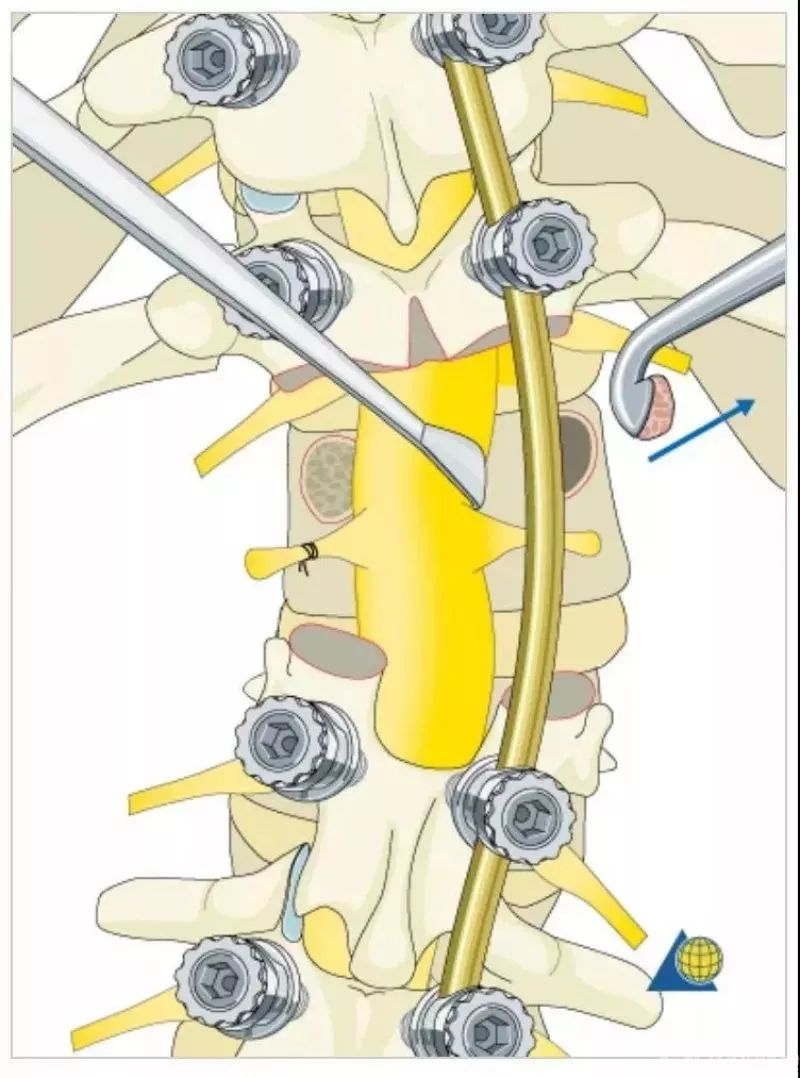 图文并茂！详解脊柱6级截骨术