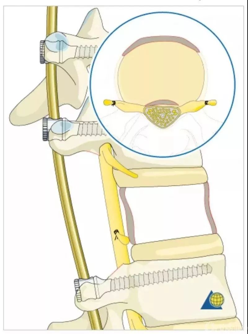 图文并茂！详解脊柱6级截骨术