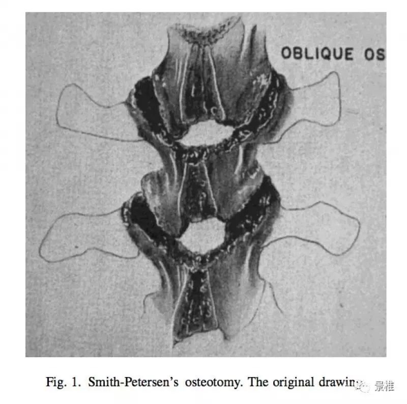 图文并茂！详解脊柱6级截骨术