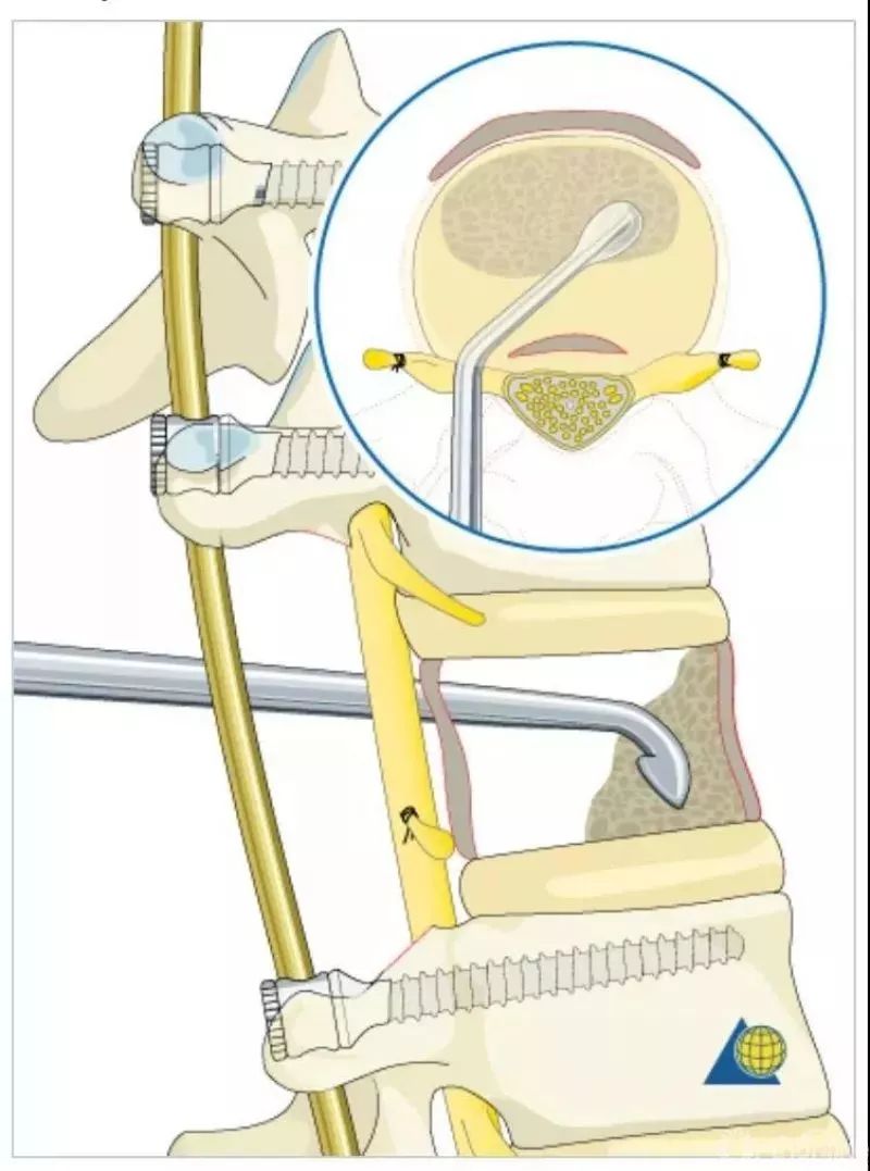图文并茂！详解脊柱6级截骨术
