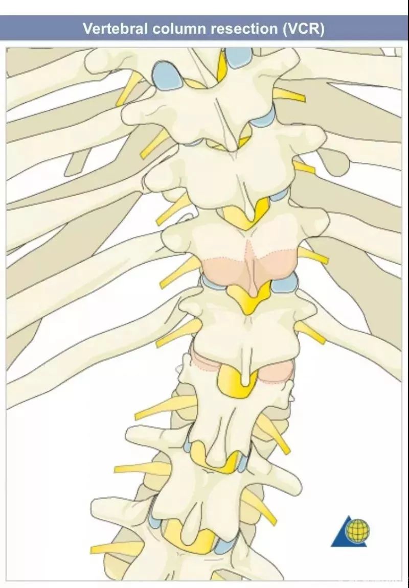 图文并茂！详解脊柱6级截骨术